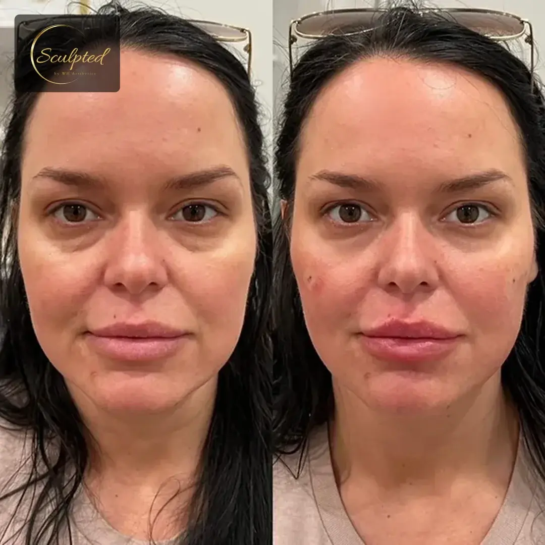 Sculpted by WH Aesthetics cheek filler result — Columbia, SC