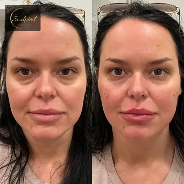 Juvederm result at Sculpted by WH Aesthetics in Columbia, SC