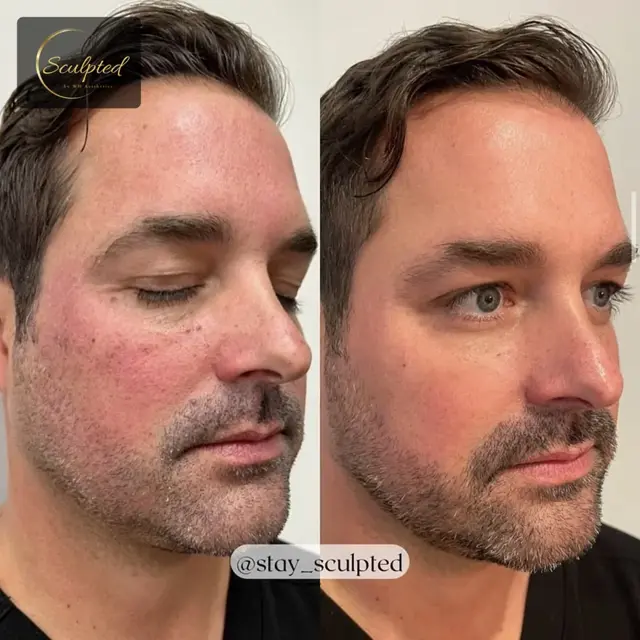 Brazilian Butt Lift result at Sculpted by WH Aesthetics in Columbia, SC