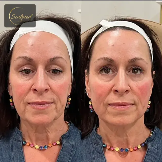 Juvederm result at Sculpted by WH Aesthetics in Columbia, SC