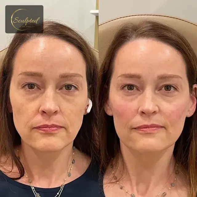Juvederm result at Sculpted by WH Aesthetics in Columbia, SC