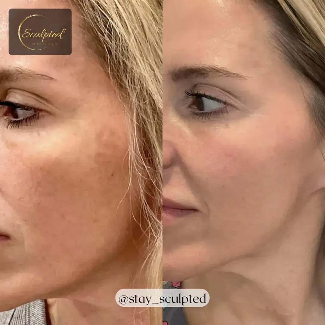Sculpted by WH Aesthetics bbl result — Columbia, SC