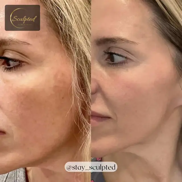 Brazilian Butt Lift result at Sculpted by WH Aesthetics in Columbia, SC