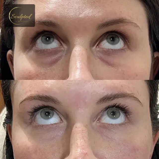Juvederm result at Sculpted by WH Aesthetics in Columbia, SC