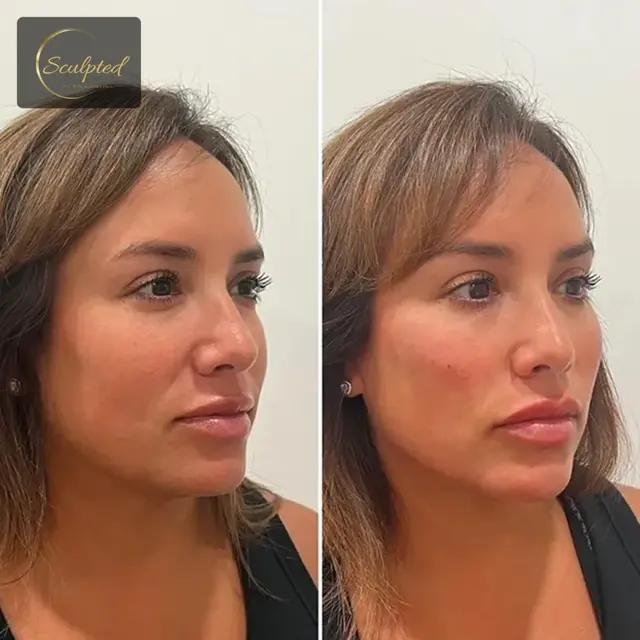 Juvederm result at Sculpted by WH Aesthetics in Columbia, SC