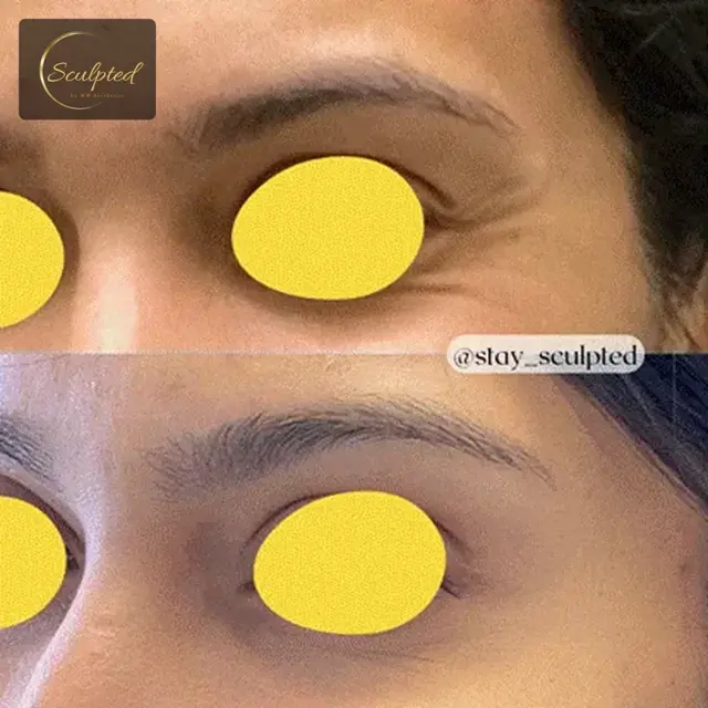 Botox result at Sculpted by WH Aesthetics in Columbia, SC