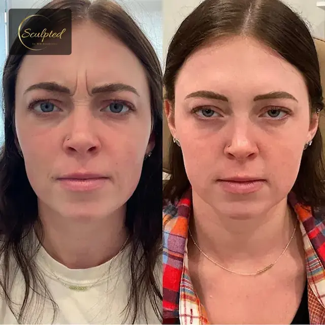 Botox result at Sculpted by WH Aesthetics in Columbia, SC