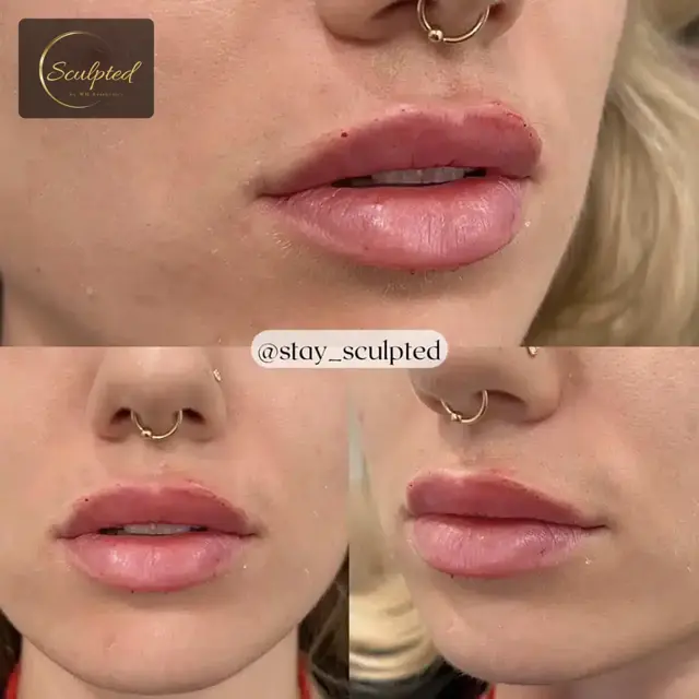 Lip Filler result at Sculpted by WH Aesthetics in Columbia, SC
