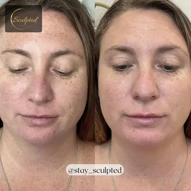 Brazilian Butt Lift result at Sculpted by WH Aesthetics in Columbia, SC