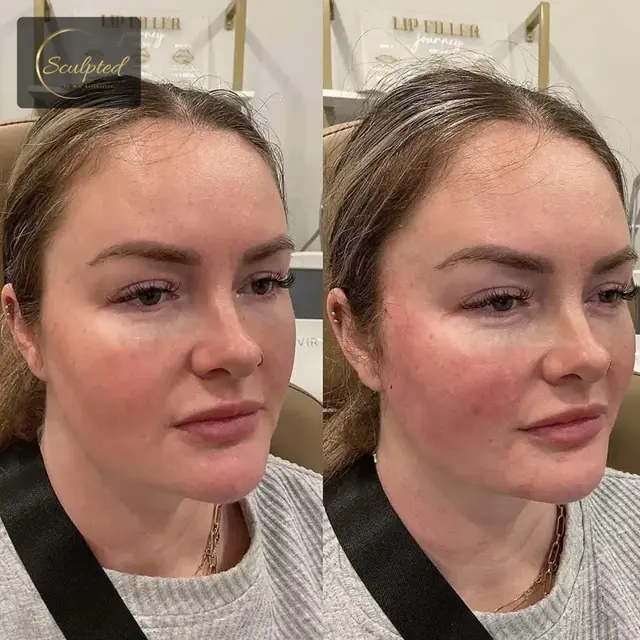 Lip Filler result at Sculpted by WH Aesthetics in Columbia, SC