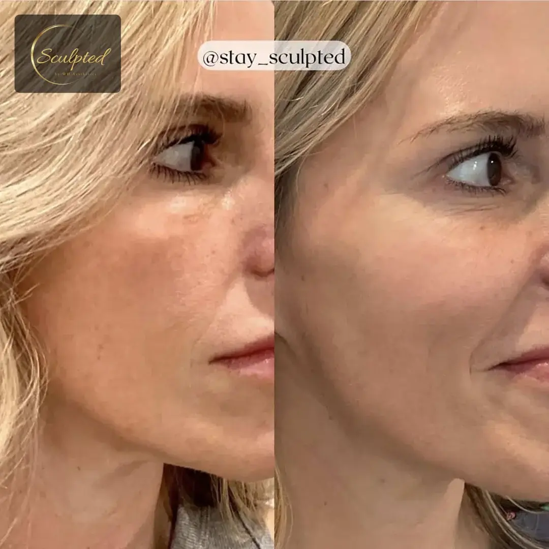 Sculpted by WH Aesthetics bbl result — Columbia, SC