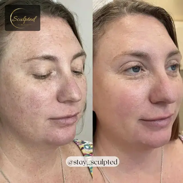 Brazilian Butt Lift result at Sculpted by WH Aesthetics in Columbia, SC