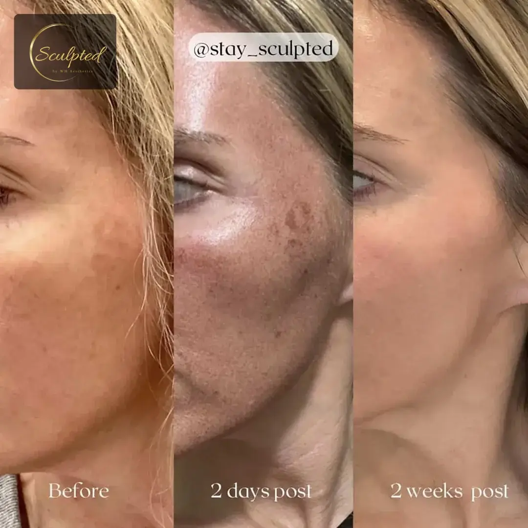 Sculpted by WH Aesthetics bbl result — Columbia, SC