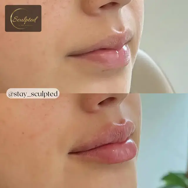 Lip Filler result at Sculpted by WH Aesthetics in Columbia, SC