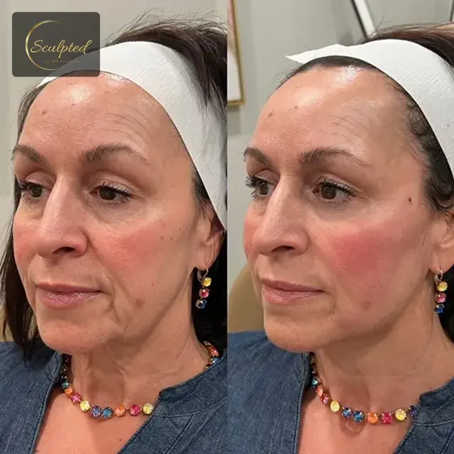 Juvederm result at Sculpted by WH Aesthetics in Columbia, SC