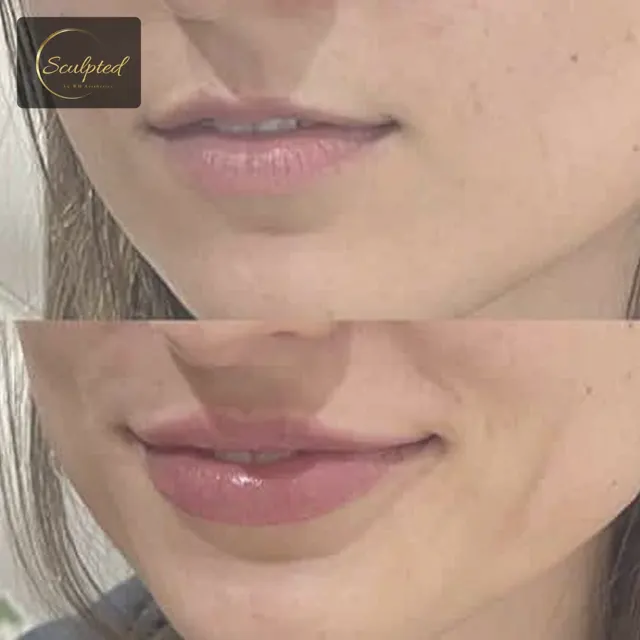 Lip Filler result at Sculpted by WH Aesthetics in Columbia, SC