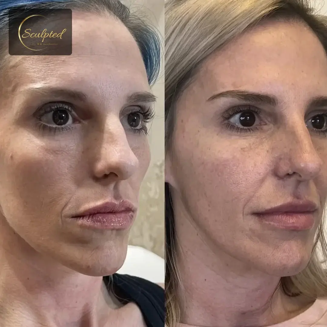 Sculpted by WH Aesthetics cheek filler result — Columbia, SC