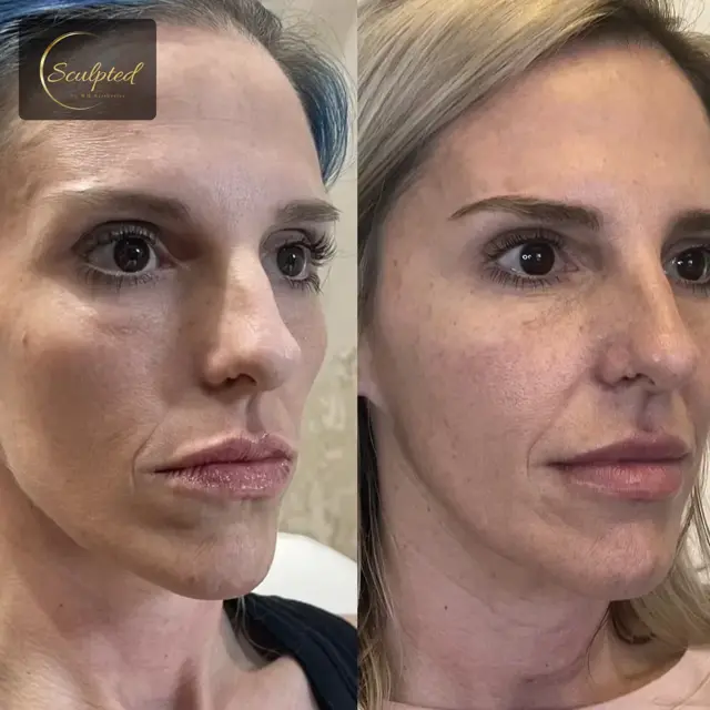 Juvederm result at Sculpted by WH Aesthetics in Columbia, SC