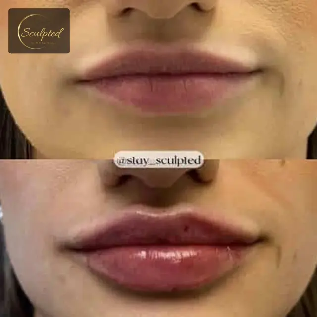 Lip Filler result at Sculpted by WH Aesthetics in Columbia, SC