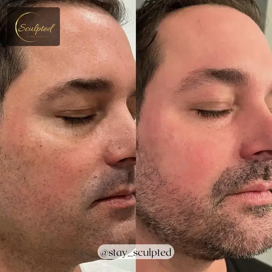 Sculpted by WH Aesthetics photofacial result — Columbia, SC