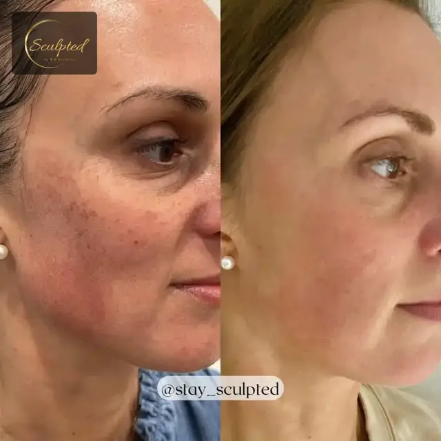 Brazilian Butt Lift result at Sculpted by WH Aesthetics in Columbia, SC