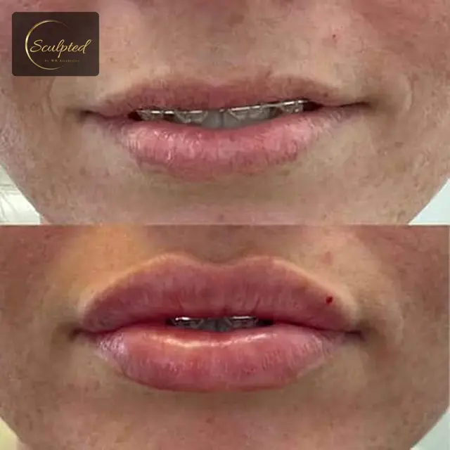 Lip Filler result at Sculpted by WH Aesthetics in Columbia, SC