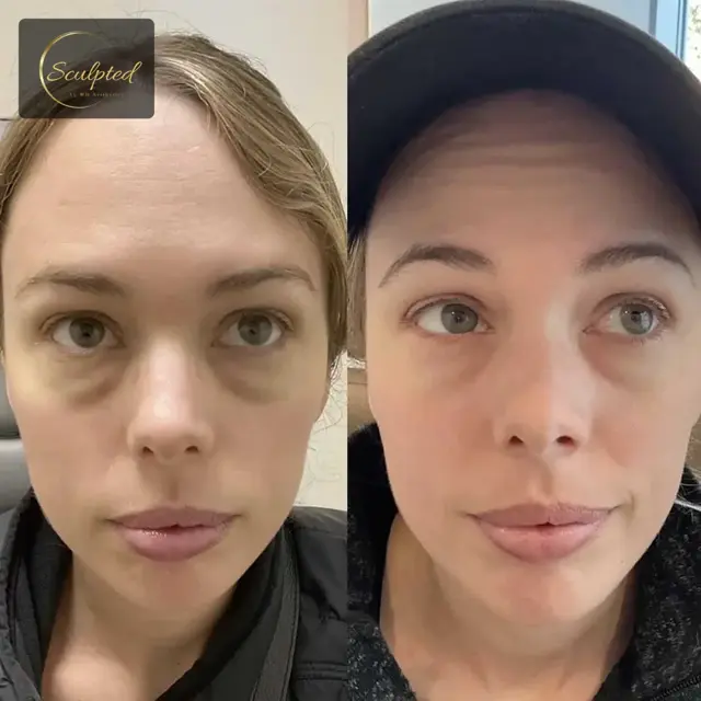 Jawline Filler result at Sculpted by WH Aesthetics in Columbia, SC