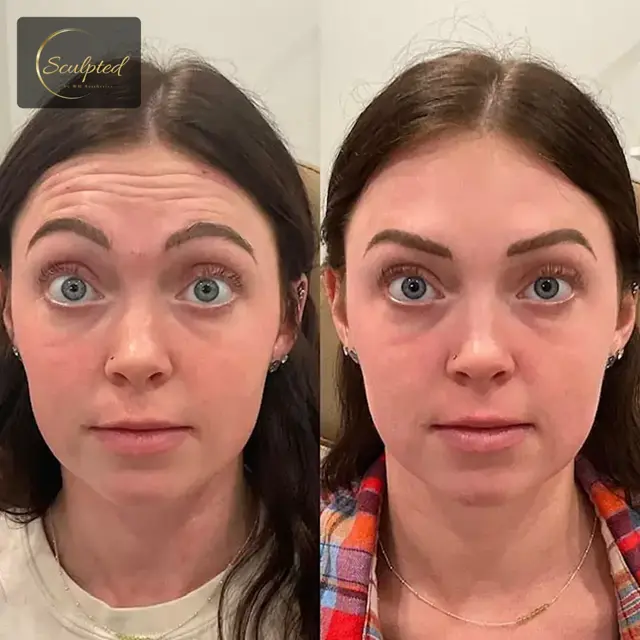 Botox result at Sculpted by WH Aesthetics in Columbia, SC