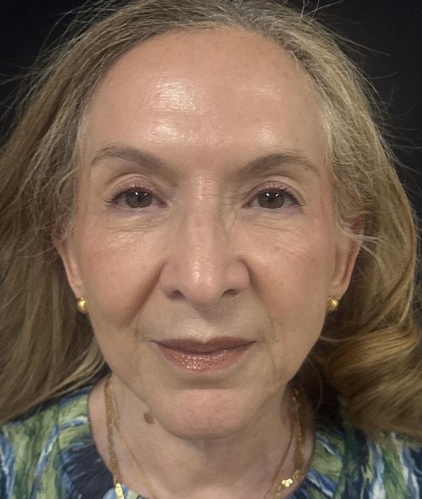 Farkas Plastic Surgery and Medical Spa facelift after — Englewood Cliffs, NJ