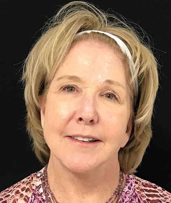 Farkas Plastic Surgery and Medical Spa facelift after — Englewood Cliffs, NJ