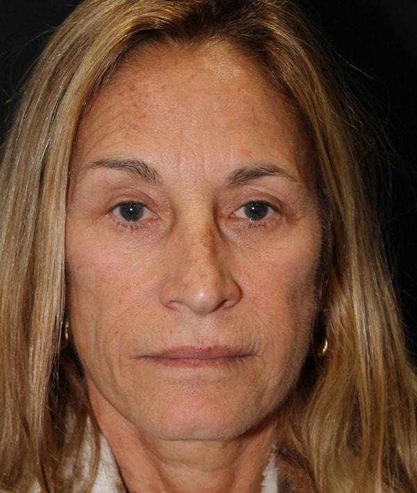 Farkas Plastic Surgery and Medical Spa facelift after — Englewood Cliffs, NJ