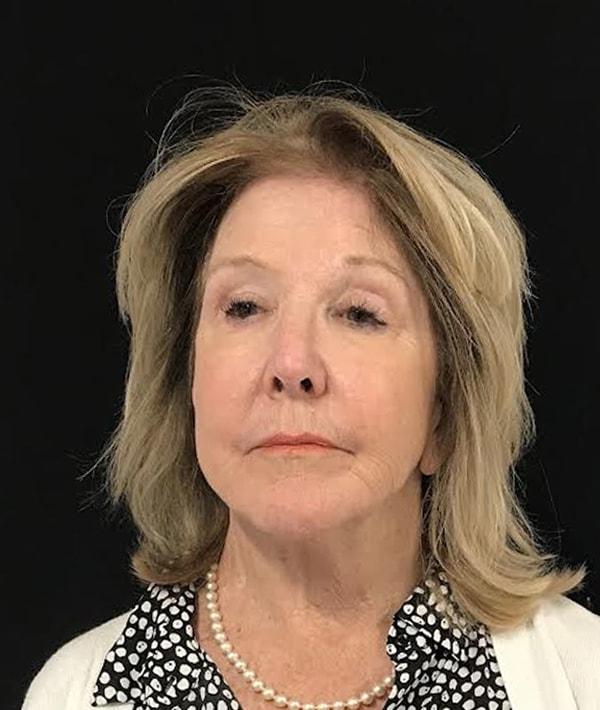 Farkas Plastic Surgery and Medical Spa facelift after — Englewood Cliffs, NJ