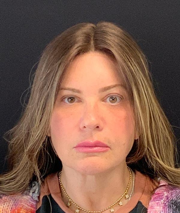Farkas Plastic Surgery and Medical Spa facelift after — Englewood Cliffs, NJ