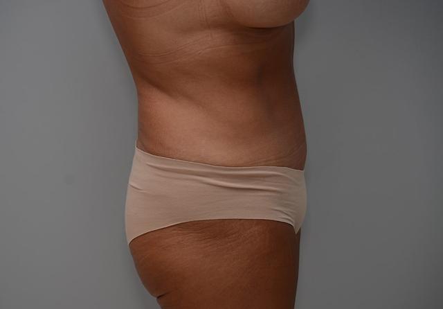 Mini Tummy Tuck after at JL Plastic Surgery in Newton, MA