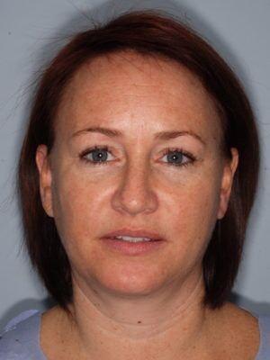 Laser Skin Resurfacing before at JL Plastic Surgery in Newton, MA