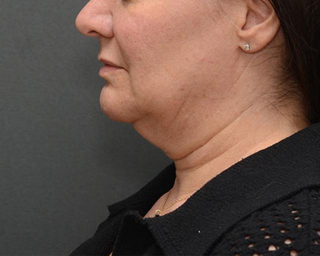 Mini Facelift before at JL Plastic Surgery in Newton, MA