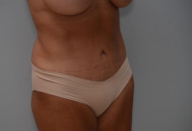 Mini Tummy Tuck after at JL Plastic Surgery in Newton, MA