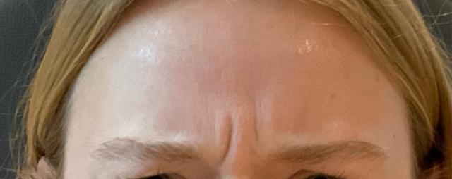 Botox before at JL Plastic Surgery in Newton, MA