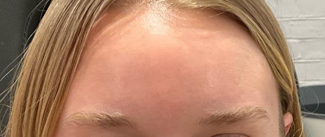 Botox after at JL Plastic Surgery in Newton, MA