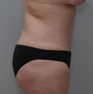 Liposuction after at JL Plastic Surgery in Newton, MA