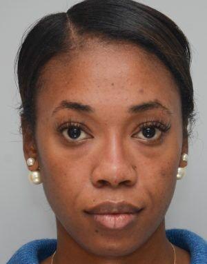 Rhinoplasty after at JL Plastic Surgery in Newton, MA