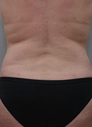 Liposuction after at JL Plastic Surgery in Newton, MA