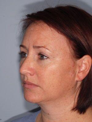 Laser Skin Resurfacing before at JL Plastic Surgery in Newton, MA