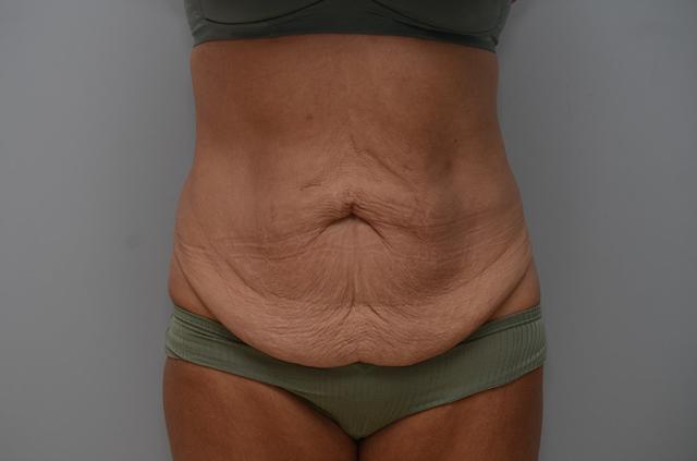Mini Tummy Tuck before at JL Plastic Surgery in Newton, MA