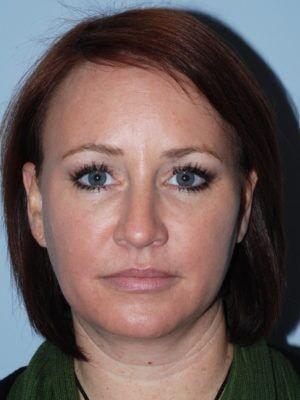 Laser Skin Resurfacing after at JL Plastic Surgery in Newton, MA