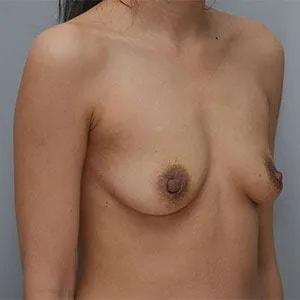 Fat Transfer Breast Augmentation before at JL Plastic Surgery in Newton, MA