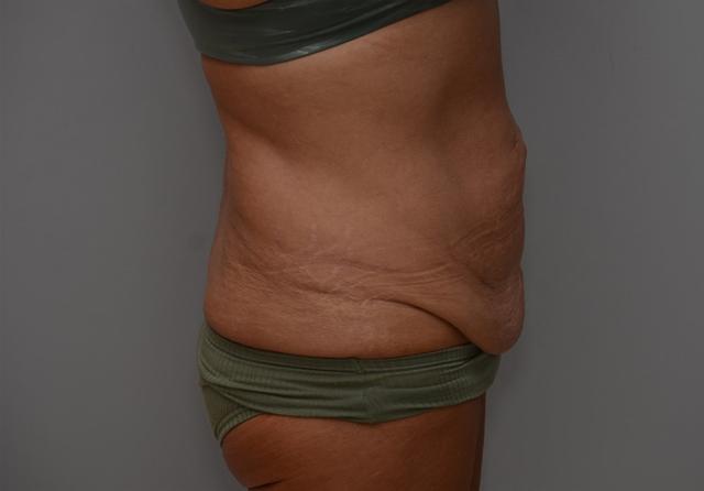 Mini Tummy Tuck before at JL Plastic Surgery in Newton, MA