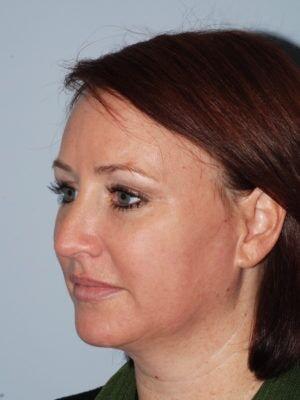 Laser Skin Resurfacing after at JL Plastic Surgery in Newton, MA