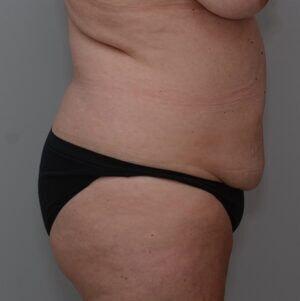 Liposuction before at JL Plastic Surgery in Newton, MA
