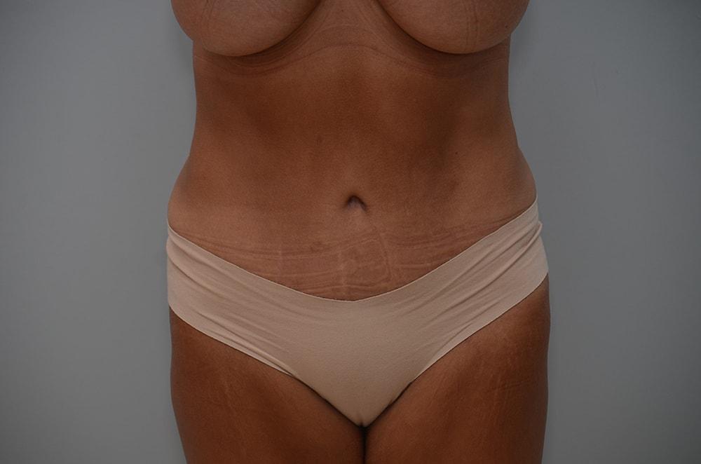 JL Plastic Surgery tummy tuck after — Newton, MA